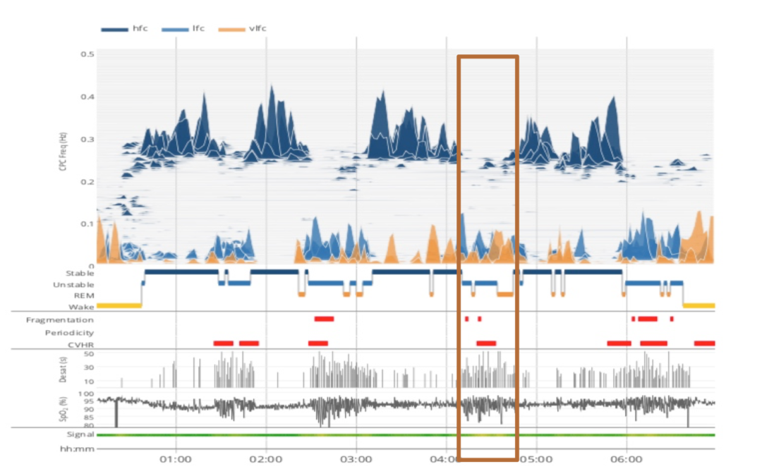 Massive Breakthrough Alert: This Hybrid Breathing Test by SleepImage Could Change How We Sleep