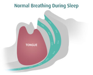 Sleep Apnea | Noum